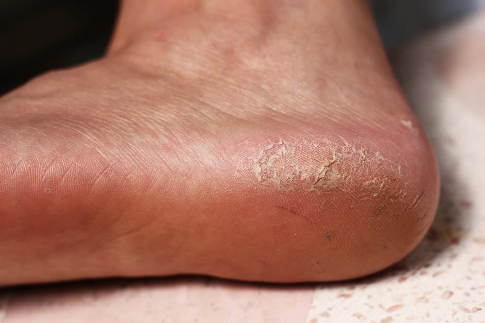 Calluses  Rochester Hills, MI 