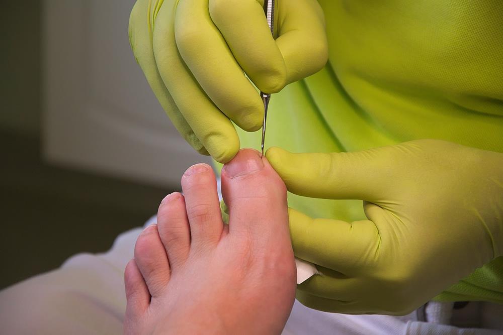 Ingrown Toenails  Rochester Hills, MI 